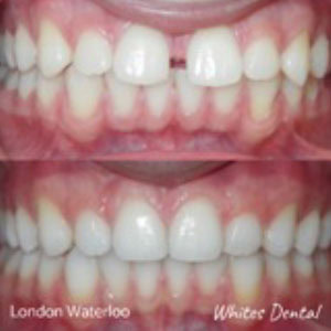 Fixed Braces For Teens in London | Orthodontist London Waterloo