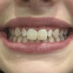 Invisalign Consultation | Whites Dental