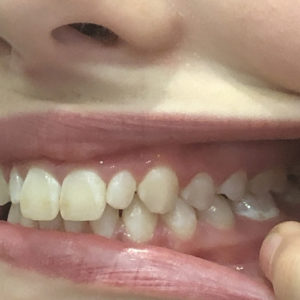 Invisalign Consultation | Whites Dental