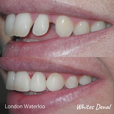 can teeth gaps be closed with composite bonding Cosmetic Destist Composite Bonding in London | Whites Dental