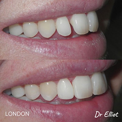 A before and after image of a dental bonding procedure.