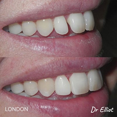 how to close gaps between front teeth in london Cosmetic Destist Composite Bonding in London | Whites Dental
