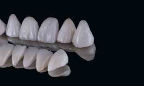 Composite Veneers | Whites Dental