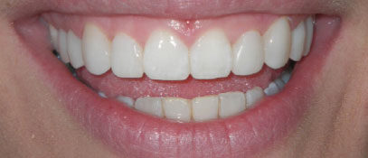 Porcelain & Composite Veneers | Whites Dental