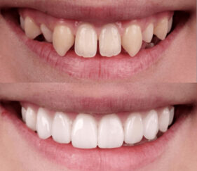 Veneers for crooked teeth. Whites Dental London Waterloo