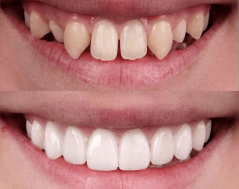 Veneers for crooked teeth. Whites Dental London Waterloo