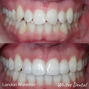 Do braces give you a lisp orthodontist in london | Whites Dental