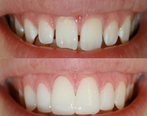 Veneers for gaps in teeth. Whites Dental London Waterloo