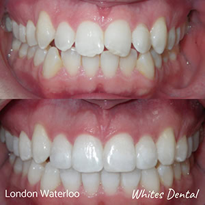 Is 35 Too Old For Braces orthodontist in london | Whites Dental