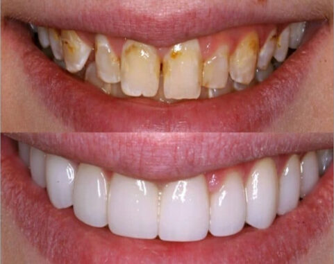 Veneers for uneven teeth. Whites Dental London Waterloo