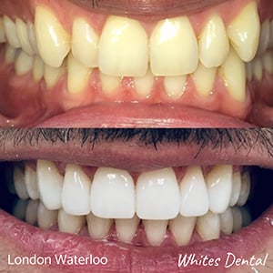 What are the side effects of braces orthodontist in london | Whites Dental