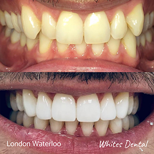 What is the shortest time to have fixed braces orthodontist in london | Whites Dental