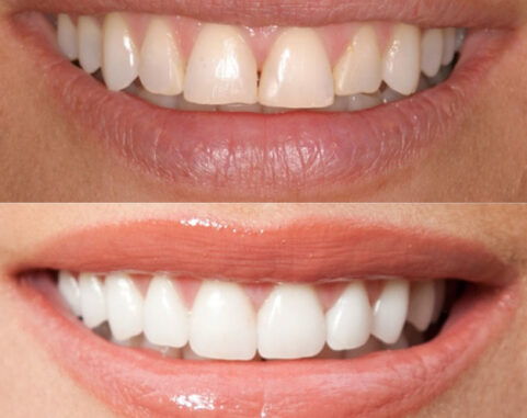 Veneers for worn chipped teeth. Whites Dental London Waterloo