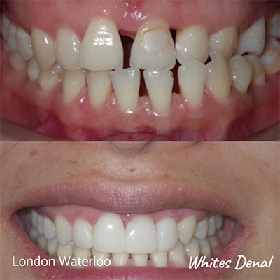 can lumineers fix crooked teeth cosmetic dentist veneers in london | Whites Dental