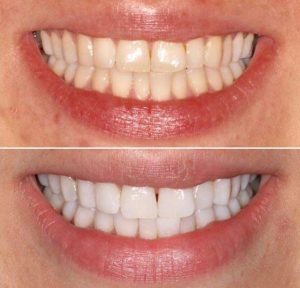 Are braces a turn off | Orthodontist in London Waterloo