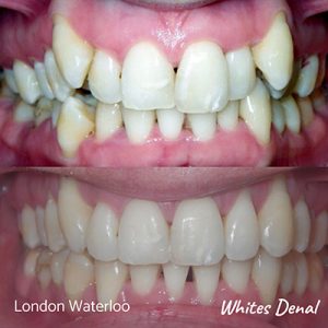 Can I drink coffee with braces | Orthodontist in London Waterloo | Whites Dental