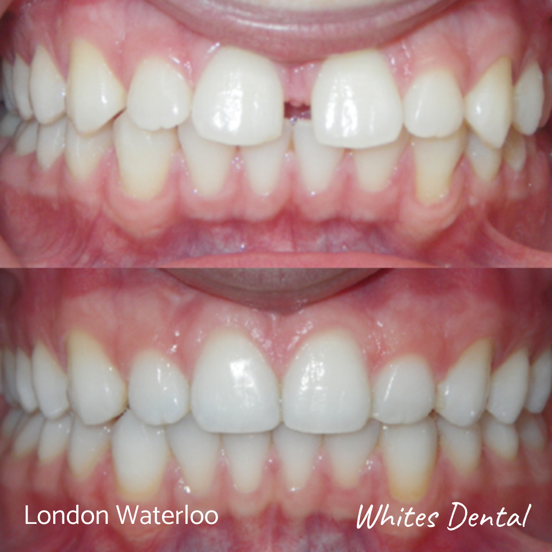 Orthodontic Braces & Invisalign In London | Whites Dental