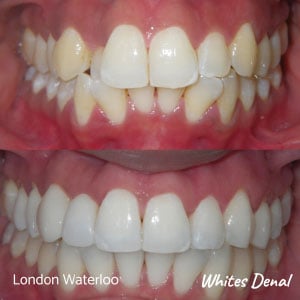Are Braces Painful | Fixed Braces in London Waterloo | Whites Dental