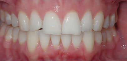 Invisalign Braces at Home | Whites Dental