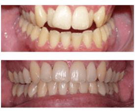 Orthodontist in London Waterloo | Whites Dental