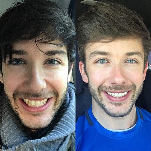 Before and after Braces photo of a London man | Whites Dental