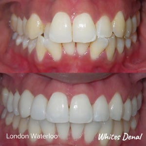 do fastbraces hurt more in london | Fixed Braces in London | Whites Dental