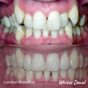 How Long Do Adults Wear Braces To Straighten Teeth in london | Whites Dental