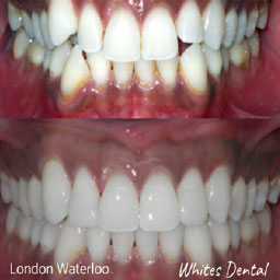 orthodontist london waterloo | Whites Dental