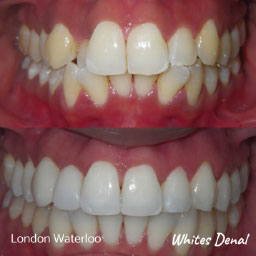 orthodontist london waterloo | Fixed Braces in London | Whites Dental