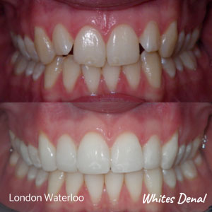 Do braces make your breath stink in London | Whites Dental