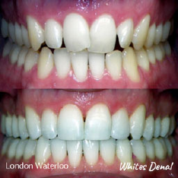 Orthodontist London Waterloo | Whites Dental