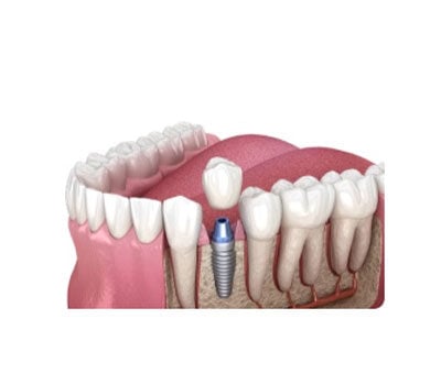Dental Implant London Waterloo | Whites Dental