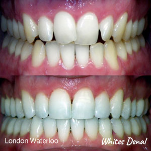 Do They Clean Your Teeth After Removing Braces Orthodontist in London Waterloo | Whites Dental