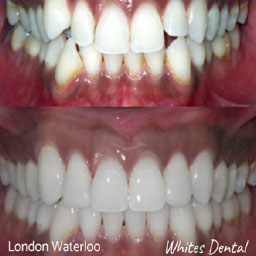Do They Clean Your Teeth After Removing Braces Whites Dental