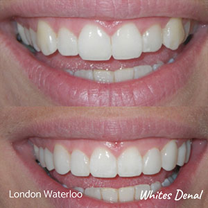 Close up image of dental veneers before and after procedure
