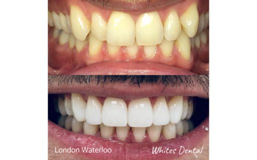 Invisalign braces, Orthodontist, Cosmetic Dentist, Reviews. London Waterloo