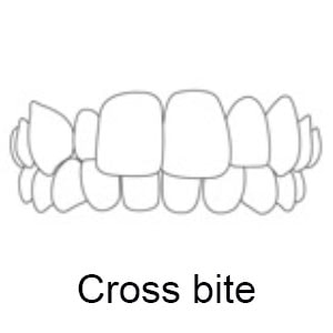 Cross Bite | Whites Dental