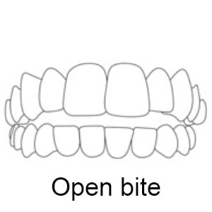 Open Bite | Whites Dental