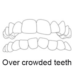 Over crowed teeth | Whites Dental