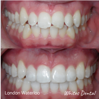 Smile Makeover | Whites Dental