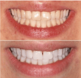 Home Teeth Whitening in London Waterloo