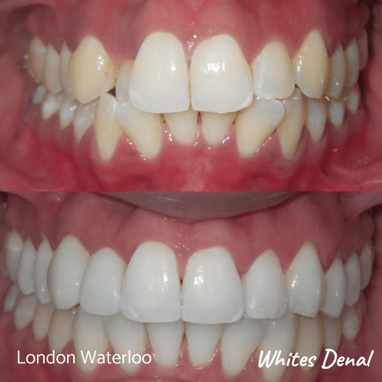 Ceramic Braces In London Waterloo