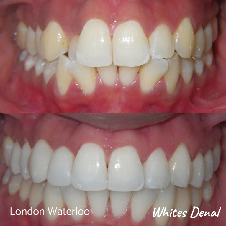 Clear Braces In London Waterloo | Whites Dental