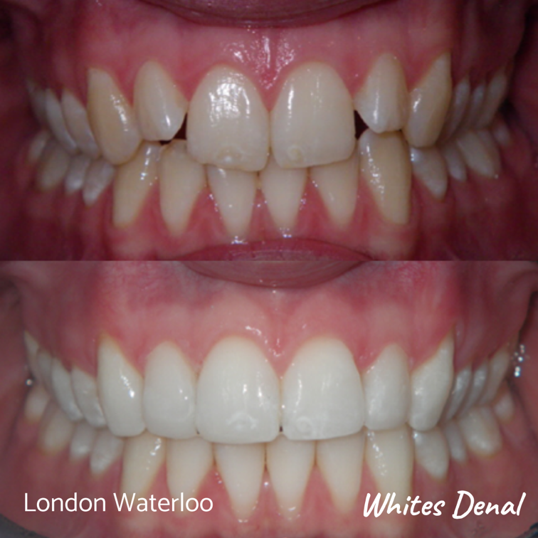 Metal Braces In London Waterloo | Whites Dental