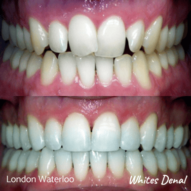 Metal Braces London Waterloo | Whites Dental