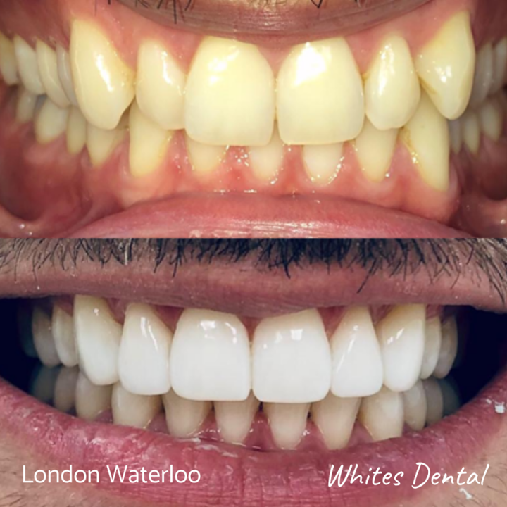 Removable Braces In London Waterloo | Whites Dental