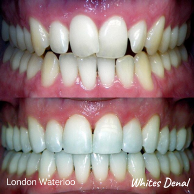 Removable Braces London Waterloo | Whites Dental