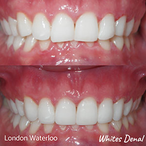 Dental bonding in London Waterloo Whites Dental | Whites Dental