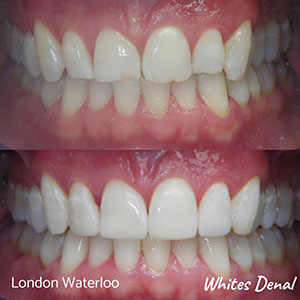 Dental bonding in London Waterloo | Whites Dental