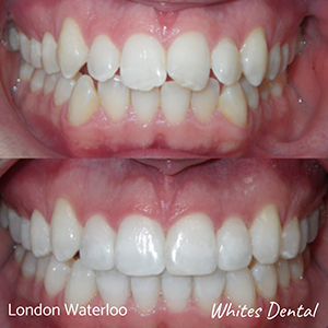 Fixed braces & orthodontist in London Waterloo | Whites Dental